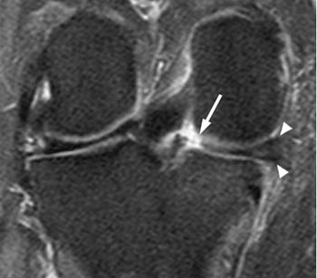 Posterior Root Tear of the Medial Meniscus - Radsource