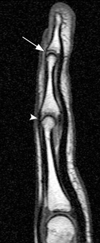 Extensor Tendon Injuries of the Finger - Radsource