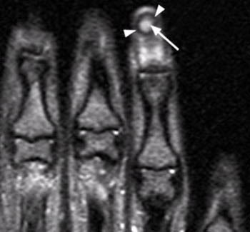 Lesions on Fingertips/Toes- Vascuilitis, Chilblains, MCTD ...