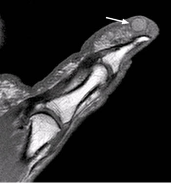 Fingertip Lesions - Radsource