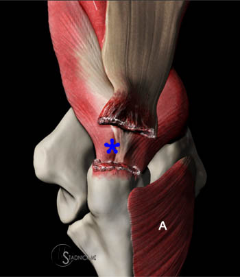 Distal Triceps Injuries - Radsource