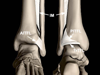 High Ankle Sprains - Radsource