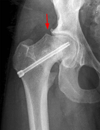 Slipped Capital Femoral Epiphysis - Radsource
