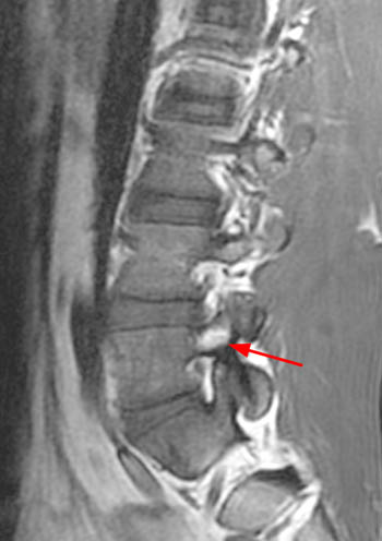 cervical and lumbar vertebrae