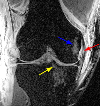 Multi-ligamentous and Tendon Injury Suggesting Knee Dislocation - Radsource