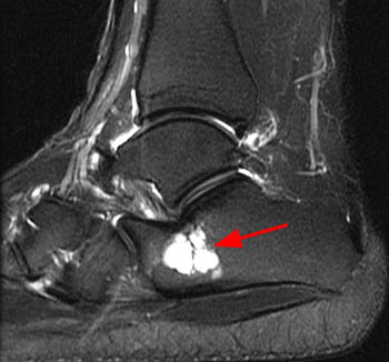 Lateral Hindfoot Impingement - Radsource