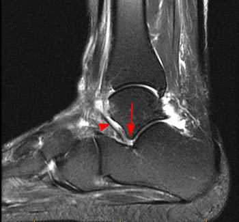 Lateral Hindfoot Impingement - Radsource