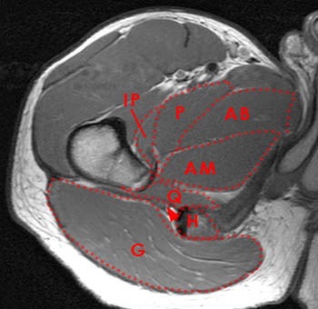 Ischiofemoral Impingement Syndrome - Radsource