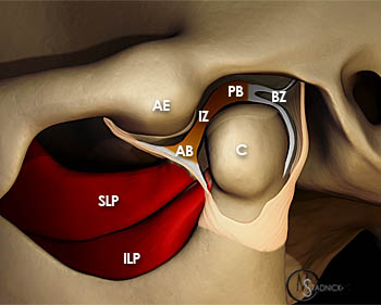 Internal Derangement of the Temporomandibular Joint - Radsource