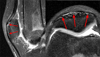 MRI of Rectus Femoris / Quadriceps Injury - Radsource