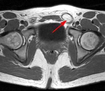 pubalgia athletic mri radsource findings posterior cord spermatic 2010 clinic