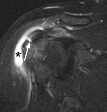 Partial Rotator Cuff Tears - Radsource