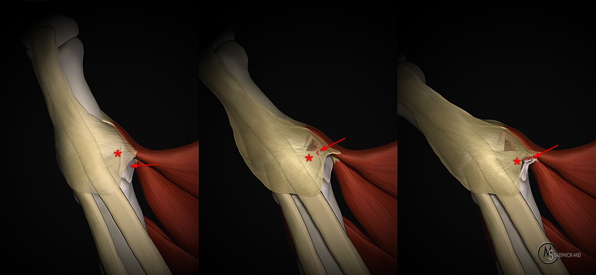 Ulnar Collateral Ligament Tears of the Thumb - Radsource