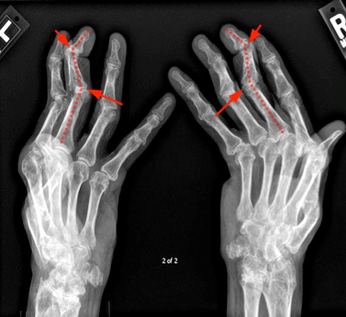 MR Imaging of Rheumatoid Arthritis - Radsource