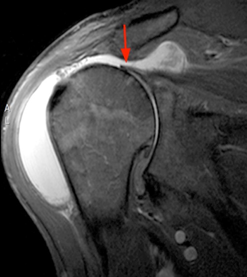 MR Imaging of Rheumatoid Arthritis - Radsource