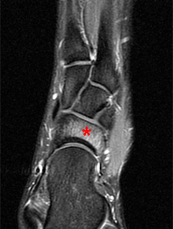 Stress fractures in the foot and ankle