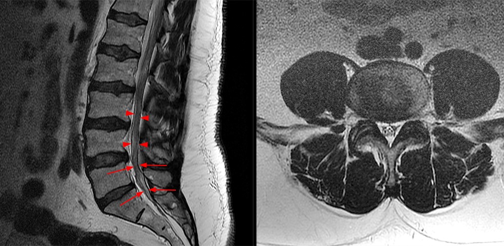 Spinal Epidural Lipomatosis with Review of Visceral Fat Deposition in