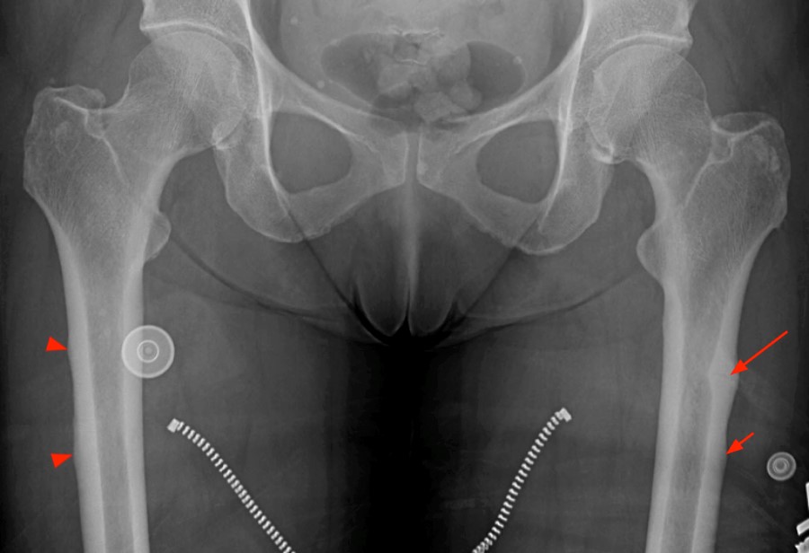 Atypical Femur Factures (AFF)