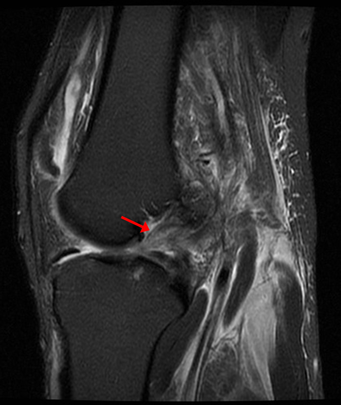 Medial Supporting Structures of the Knee with Emphasis on the Medial