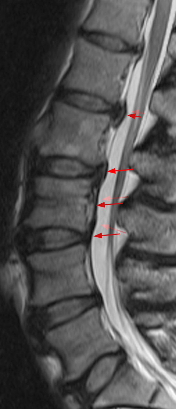 Ossification of the Posterior Longitudinal Ligament: Bone in a Bad