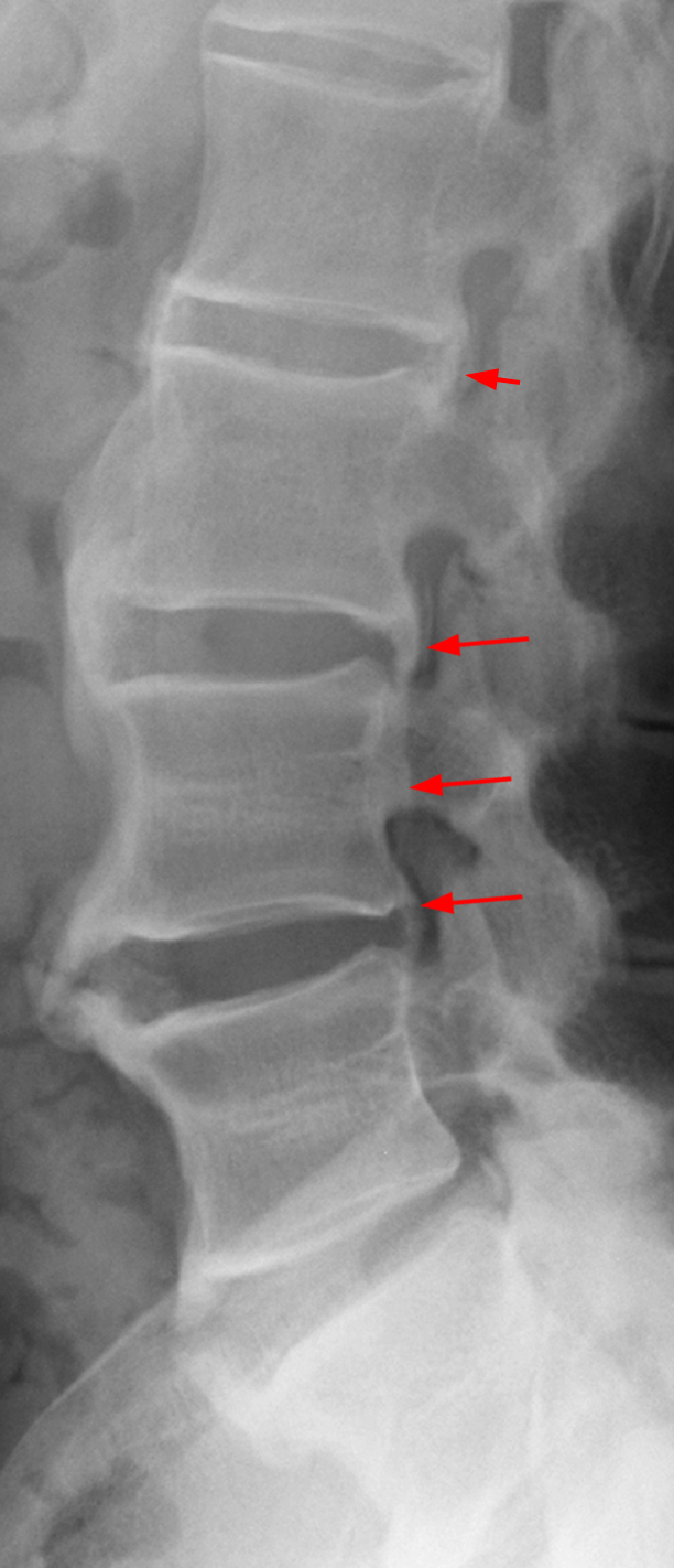 Ossification of the Posterior Longitudinal Ligament: Bone in a Bad
