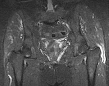 Hip Bursitis MRI