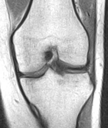 Iliotibial Band Friction Syndrome (Runner's Knee): Diagnosis and
