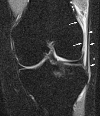 iliotibial band syndrome x ray)
