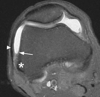 iliotibial band syndrome radiology