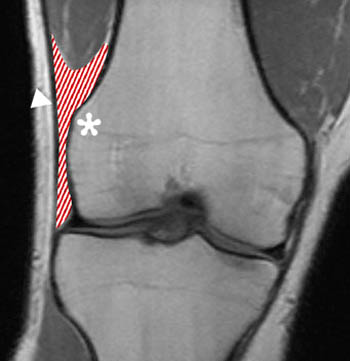 iliotibial band syndrome x ray