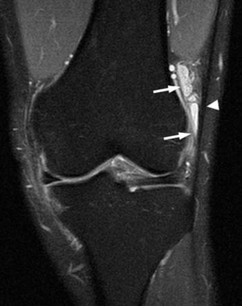 iliotibial band syndrome x ray