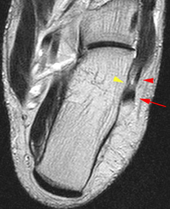 Peroneal Tendon Dislocation and Superior Peroneal Retinaculum Injury