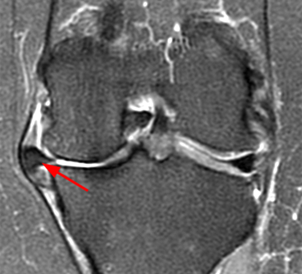 Дистрофические изменения заднего рога. Повреждение медиального мениска коленного сустава мрт. Разрыв медиального мениска коленного сустава рентген.