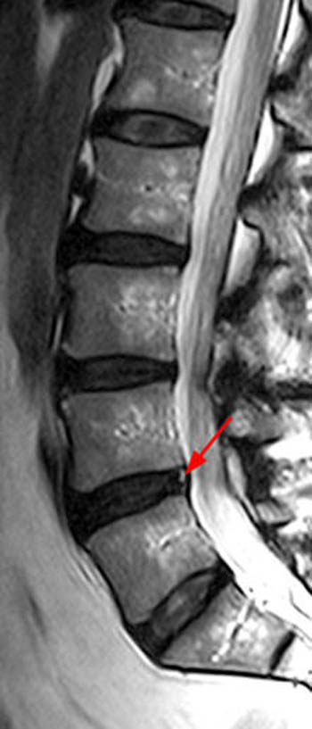térd osteoarthritis gél fájdalom a gerinc bal oldalán