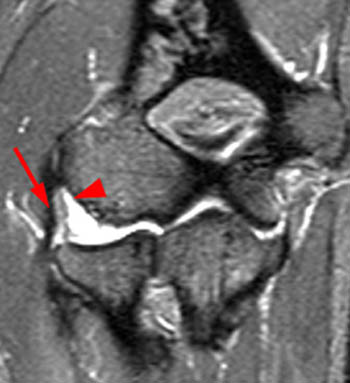 Radial Lateral Ligament Tear