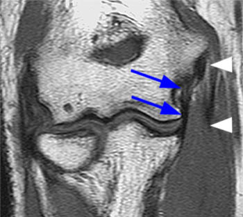 Ulnar Collateral Ligament Tears of the Elbow - Radsource