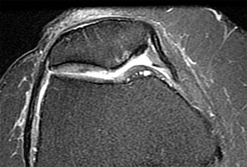 osteoarthritis radiology knee