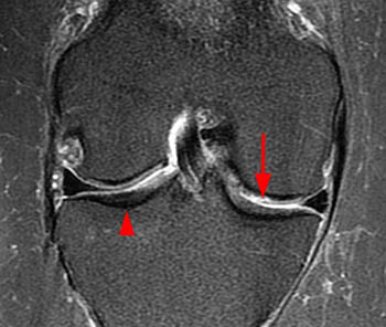 A csont szerepe a térdízületi gyulladásban (OA) - Osteoarthritis knee mri