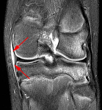 knee injury radsource mri posteromedial corner 1b 2b