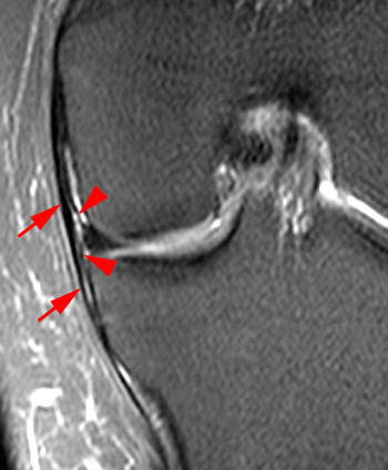 Posteromedial Corner Injury of the Knee - Radsource