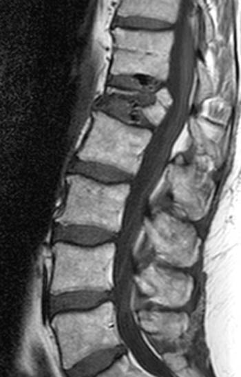 MRI of THORACOLUMBAR SPINE IMPRESSION: Moderate Pathological
