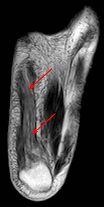Foot Muscles Mri - Fasciae Of The Musculoskeletal System Mri Findings In Trauma Infection And Neoplastic Diseases Insights Into Imaging Full Text - The muscles acting on the foot can be divided into two distinct groups;