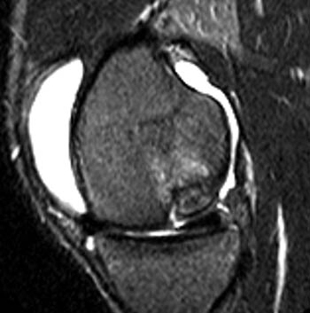 osteochondritis dissecans knee mri azitromicin ízületi gyulladás
