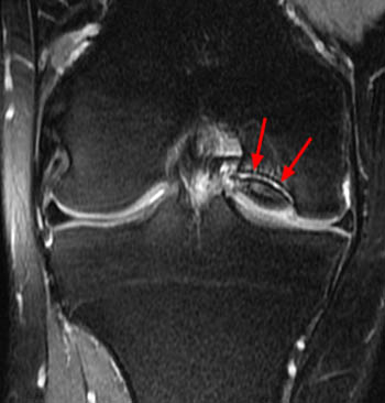 osteochondritis dissecans knee mri csípő chondroma kezelés