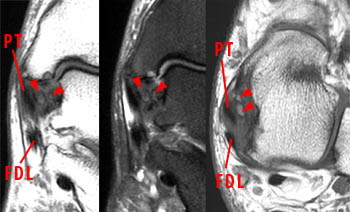 Deltoid ligament injury  Radiology Reference Article