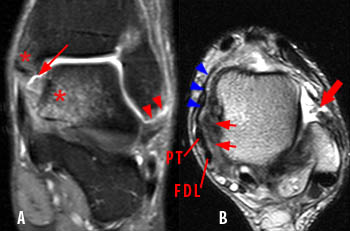 MR images of deltoid ligament anatomy. Coronal proton-density fast