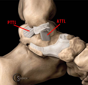 anterior talofibular ligament swelling