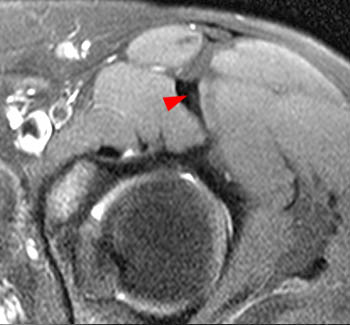 MRI of Rectus Femoris / Quadriceps Injury - Radsource