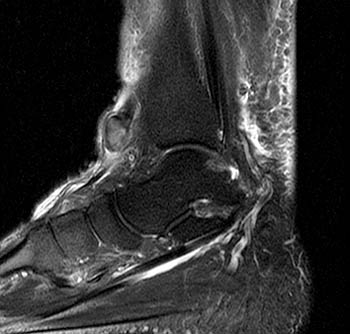 Ankle Extensor Tendon Pathology - Radsource