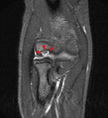 Osteochondral Injury of the Elbow - Radsource
